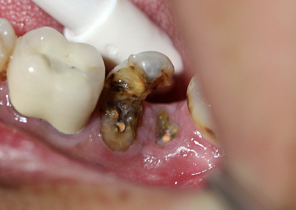Chez les patients âgés, l'ablation des racines des dents cariées ne présente généralement pas de grandes difficultés.