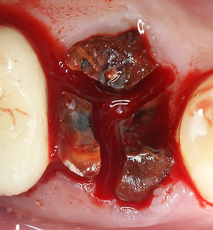 Les racines de la dent sont séparées par un foret pour simplifier la procédure pour les retirer du trou.