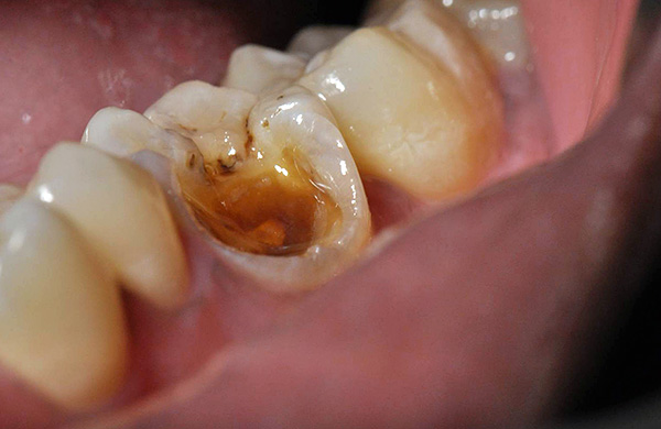 Si un morceau, même gros, se détache de la dent, cela ne signifie pas que vous devez vous séparer de la dent.