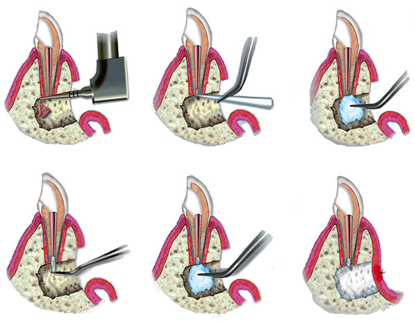 Les images montrent schématiquement la procédure de résection de l'apex de la racine de la dent.