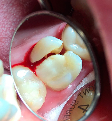 Avec une telle fracture de la dent, elle est généralement sujette à un retrait.