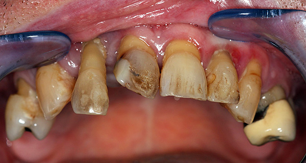 Un autre exemple de l'état des dents de la mâchoire supérieure avant traitement ...