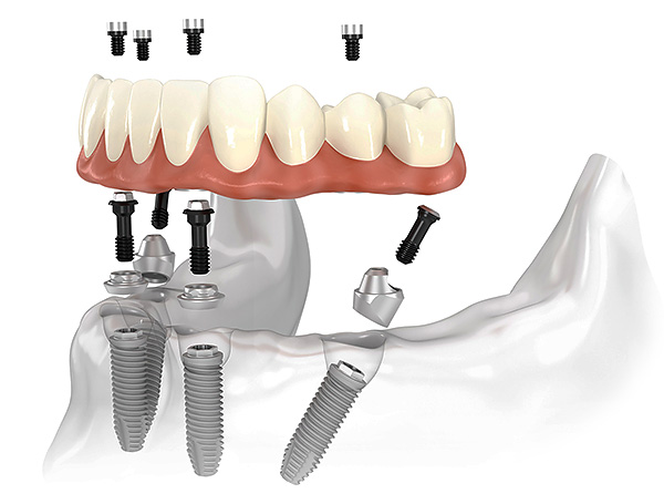 L'image représente schématiquement le concept de la technologie de prothèse dentaire All-on-4.