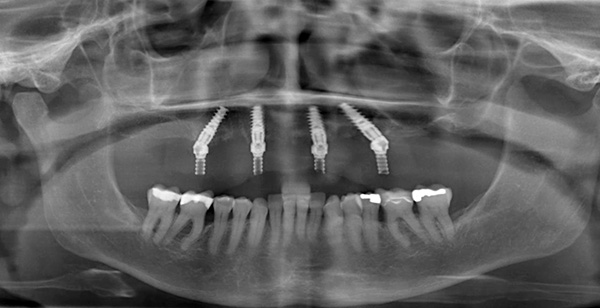 L'image montre que deux implants sont fixés verticalement, et deux - à un angle.