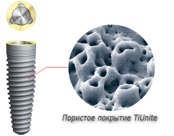 La surface des implants en titane a un revêtement poreux spécial qui facilite le processus de fusion de l'implant avec le tissu osseux.
