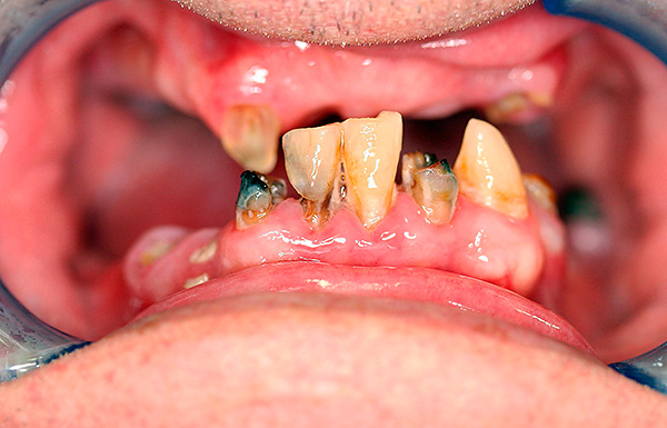 La photo montre l'état des dents du patient avant les prothèses.