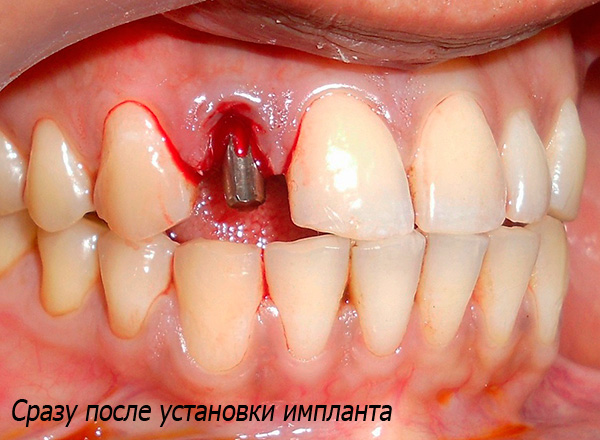L'implantation immédiate implique l'installation d'un implant dans le trou immédiatement après l'extraction dentaire.
