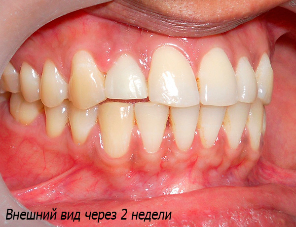 Voilà à quoi ressemble le résultat de l'implantation après 2 semaines - une dent artificielle ne peut pas être distinguée de ses proches.