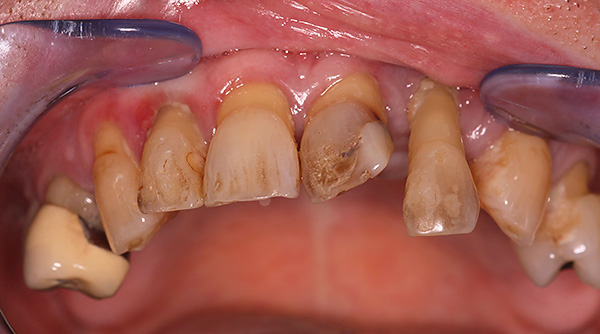 La photo montre l'apparence des dents avant les prothèses ...