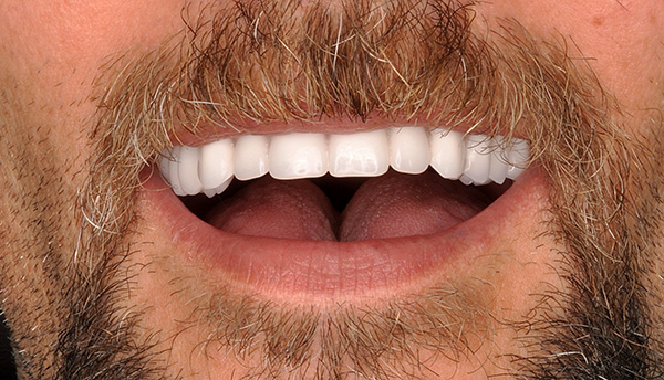 L'implantation de dents avec une charge immédiate vous permet d'obtenir un tel sourire en peu de temps au prix d'environ 300 000 roubles.