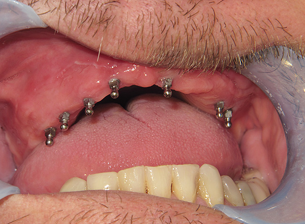 Avec la soi-disant mini-implantation des dents, la prothèse peut être installée quelques jours seulement après l'implantation des mini-implants.