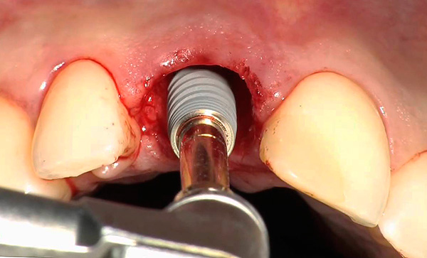 La photo montre un exemple d'installation d'un implant dans le puits d'une dent qui vient d'être retirée.