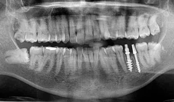 Les implants dits basaux sont implantés dans les sections profondes de l'os de la mâchoire.