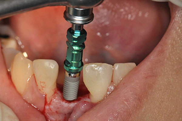 Étape de pose d'implant dentaire