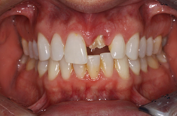 Après le retrait de la racine, la dent avant peut être restaurée sur l'implant.