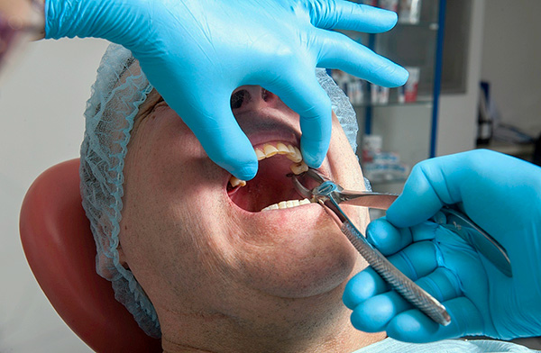 La dent est fermement maintenue dans le trou par l'appareil ligamentaire, de sorte que le médecin doit faire des efforts importants lors du desserrage.