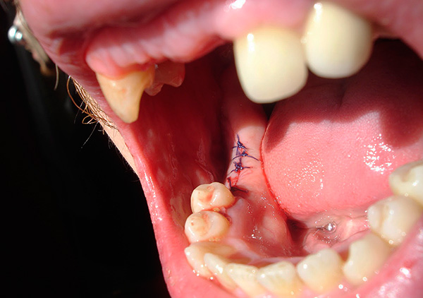 Avec une plaie importante formée après l'extraction dentaire, le chirurgien-dentiste peut piquer.