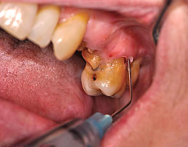 La qualité de l'anesthésie dépend complètement de l'intensité de la douleur lors de l'extraction dentaire.