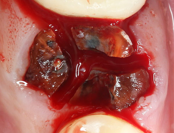 La dent est sciée en trois parties (par le nombre de racines) de sorte qu'il est plus facile de l'enlever avec un minimum de traumatisme aux tissus environnants.