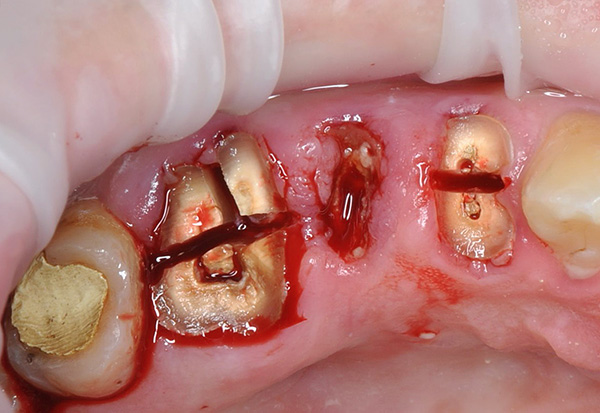 Avant de retirer les dents, les dents sont sciées par un foret en pièces ...