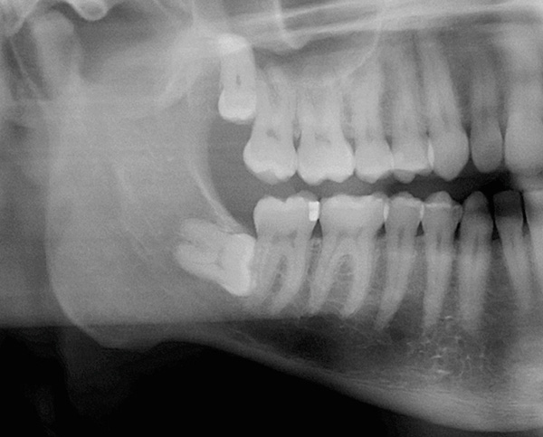 La rétine de la dent de sagesse située horizontalement dans l'os de la mâchoire inférieure est clairement visible sur l'image.