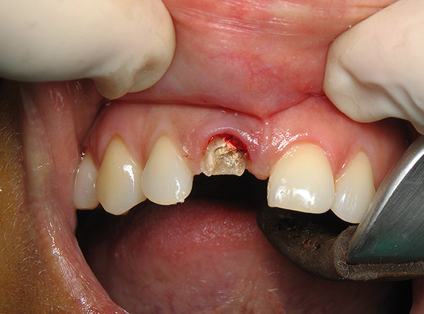 L'attitude inadéquate des patients face au problème de l'extraction dentaire et la faible prise de conscience de cette opération entraînent souvent de graves conséquences.