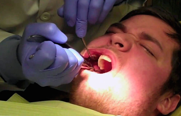 Pour que la procédure d'extraction dentaire se déroule sans problème, il est utile de connaître certaines nuances ...