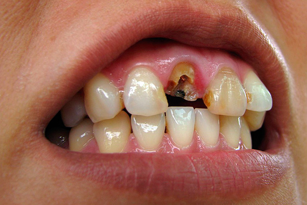 Souvent, la dent se casse de sorte que la racine ne peut plus être utilisée comme support pour l'insert et la couronne - dans ce cas, la racine est soumise à une extraction.