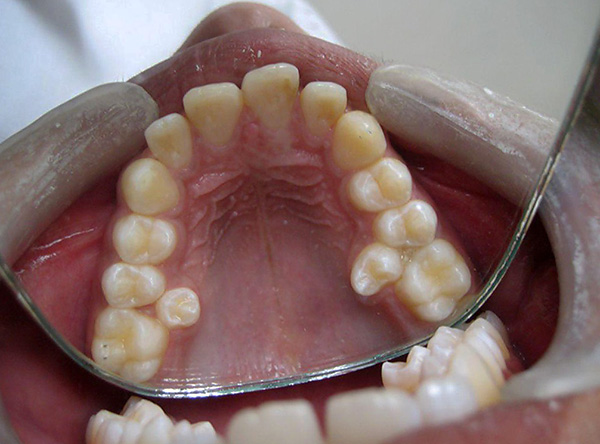 Les dents surnuméraires sont généralement retirées.