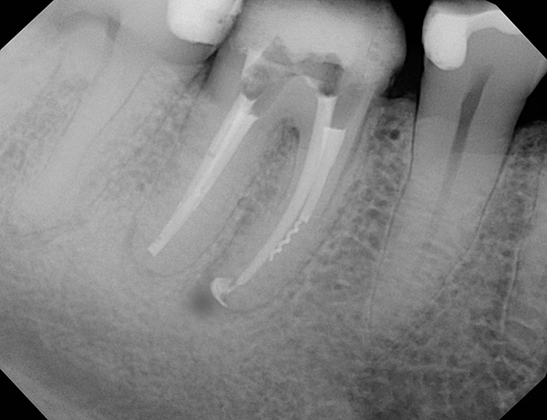 Le fragment d'un instrument dentaire dans le canal radiculaire de la dent est clairement visible sur l'image - souvent cela conduit finalement à une inflammation de la racine.