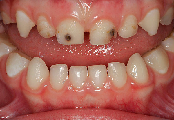 Même les dents de lait, si nécessaire, doivent être traitées pour éviter une perte prématurée.