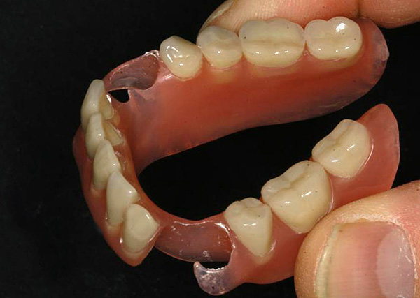 Avec un grand nombre de dents manquantes dans la bouche, l'utilisation d'une prothèse en nylon sera loin d'être la meilleure option pour les prothèses ...
