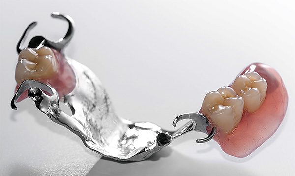 L'option la plus simple pour une prothèse à fermoir amovible est une structure montée sur les dents avec des crochets métalliques (fermoirs).