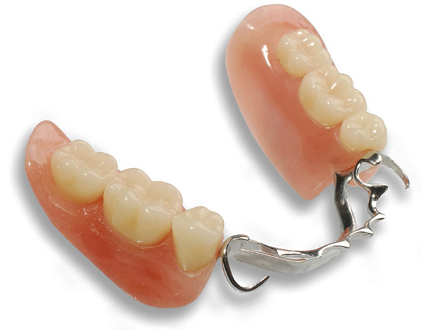 Dans de nombreux cas cliniques, l'utilisation d'une prothèse à fermoir est la meilleure option pour les prothèses de dents manquantes.