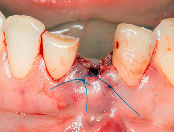 Les prothèses dentaires immédiates sont utilisées pour restaurer l'esthétique presque immédiatement après l'extraction dentaire.