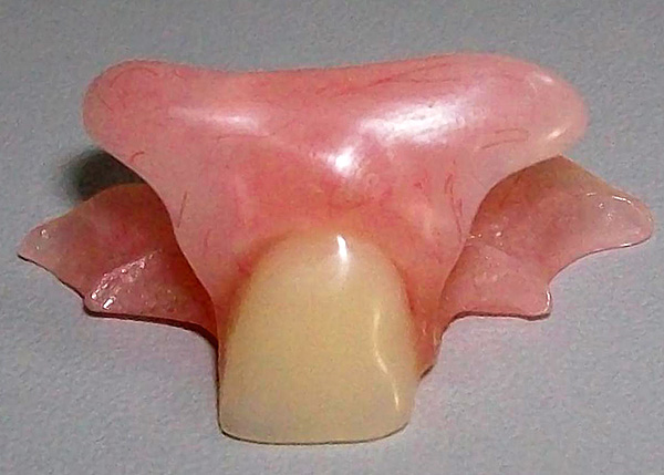 Prothèse dentaire immédiate
