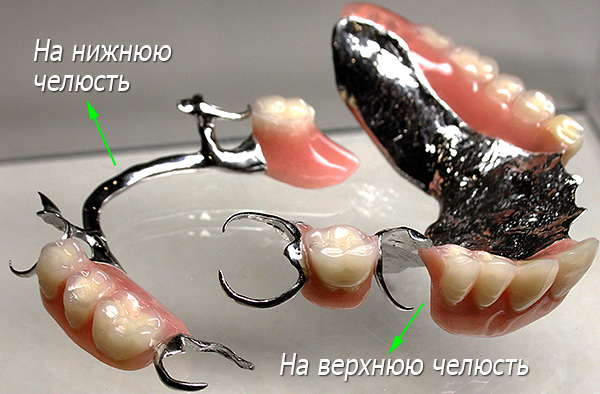 Fermeture des prothèses dentaires sur la mâchoire supérieure et inférieure avec fixation sur les fermoirs.