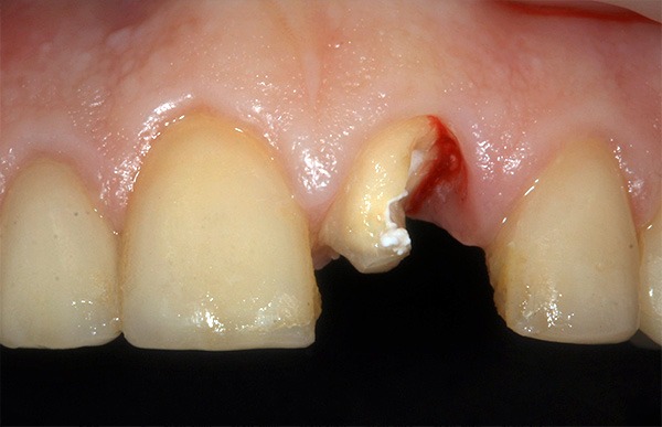 Cas clinique: la dent avant est cassée à cause d'une blessure mécanique.