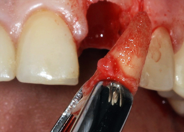 Afin de réaliser une implantation immédiate, la racine de la dent doit être retirée aussi précisément que possible, sans endommager les parois osseuses du trou.