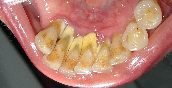 La photo montre un exemple typique de l'état des dents avec un niveau d'hygiène buccale insatisfaisant.