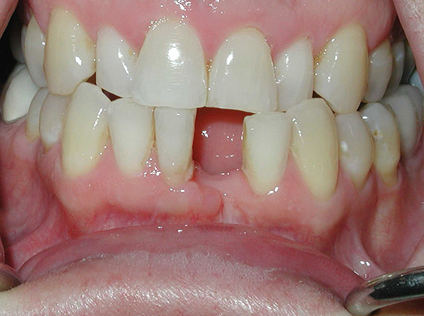 La situation avant le traitement - il n'y a pas de dent avant du bas.