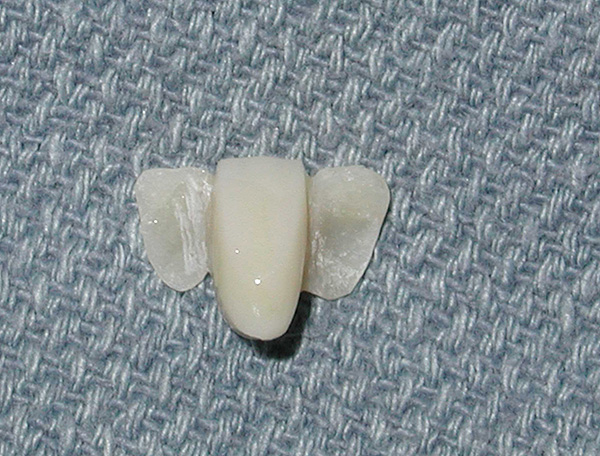 La prothèse a des plaques spéciales sur le côté qui seront collées aux dents du pilier.