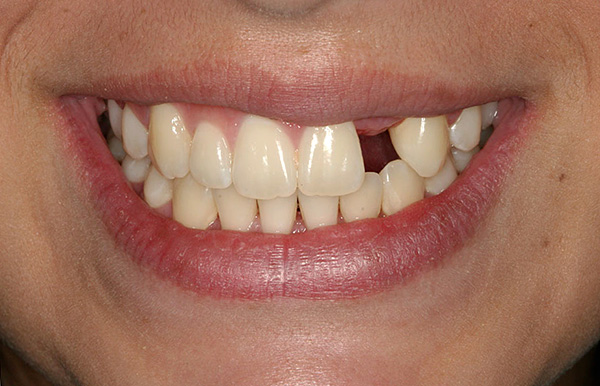 La perte d'une seule dent sans prothèse rapide peut affecter très négativement l'état de la dentition entière.