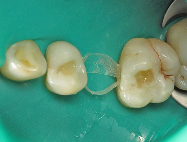 Entre les dents s'étire la base en fibre de verre de la future prothèse.