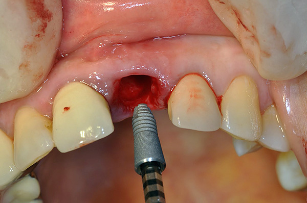 Exemple d'installation d'implant Astra Tech