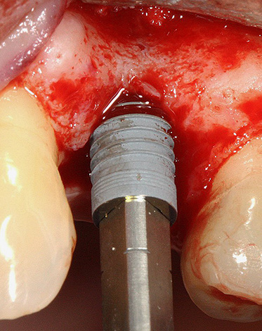 Insertion d'un implant dans le puits d'une dent qui vient d'être retirée.