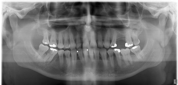 L'orthopantomogramme vous permet d'évaluer l'état des dents et des tissus adjacents.
