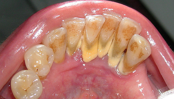 Avant d'effectuer une implantation dentaire, il est important d'éliminer tous les foyers d'accumulation de bactéries dans la cavité buccale (y compris l'élimination du tartre).