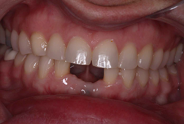 Dans la situation montrée sur la photo, les deux dents inférieures avant pourraient être restaurées à l'aide d'un bridge conventionnel.