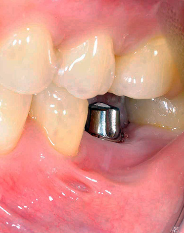 Implant dentaire à mâcher.